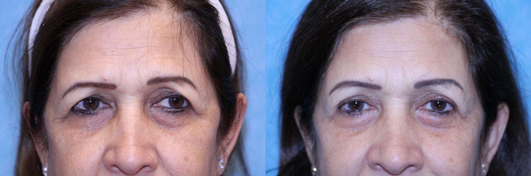 Before & After Brow Lift Case 558 Front View in Toledo, Ohio