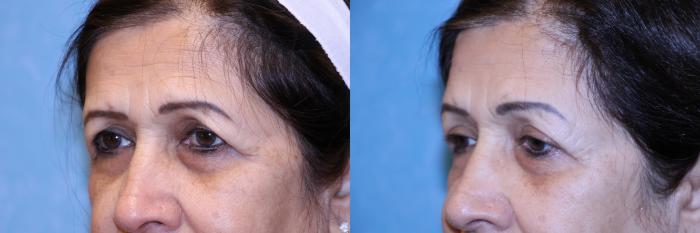 Before & After Brow Lift Case 558 Left Side View in Toledo, Ohio