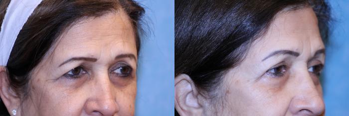 Before & After Brow Lift Case 558 Right Side View in Toledo, Ohio