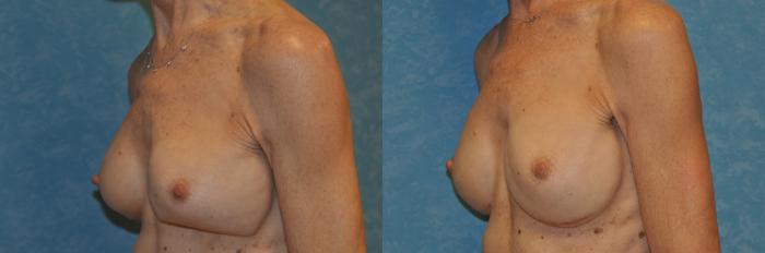 Before & After Complex Cases Case 401 Left Oblique View in Toledo, Ohio