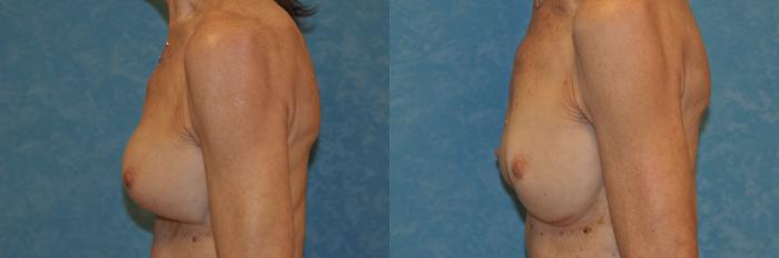 Before & After Complex Cases Case 401 Left Side View in Toledo, Ohio