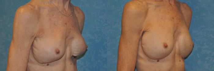 Before & After Complex Cases Case 401 Right Oblique View in Toledo, Ohio