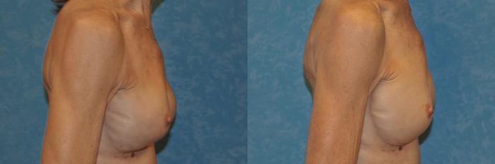 Before & After Complex Cases Case 401 Right Side View in Toledo, Ohio