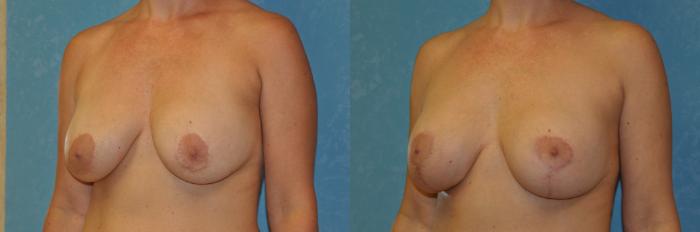 Before & After Complex Cases Case 405 Left Oblique View in Toledo, Ohio
