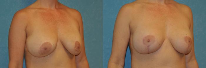 Before & After Complex Cases Case 405 Right Oblique View in Toledo, Ohio