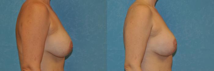 Before & After Complex Cases Case 405 Right Side View in Toledo, Ohio