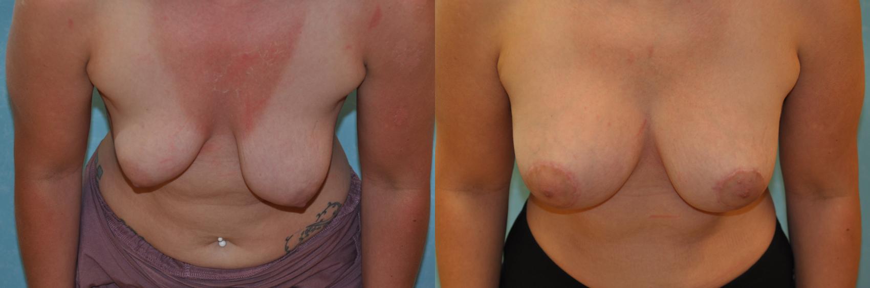 Before & After Breast Lift Case 417 Bent Forward View in Toledo, Ohio