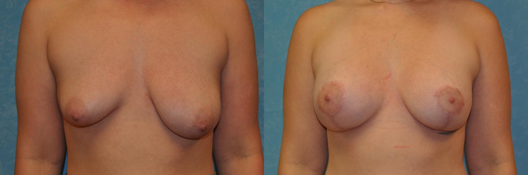 Before & After Breast Lift Case 417 Front View in Toledo, Ohio