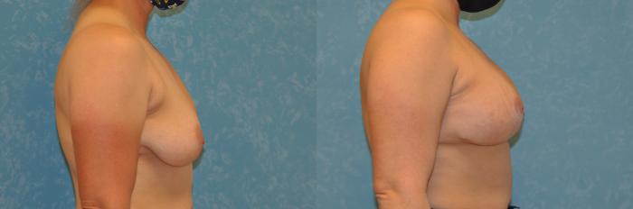 Before & After Complex Cases Case 451 Right Side View in Toledo, Ohio