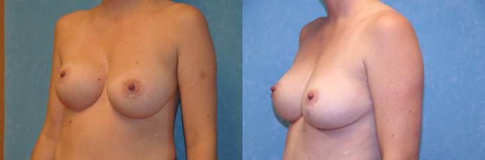 Before & After Complex Cases Case 462 Left Oblique View in Toledo, Ohio