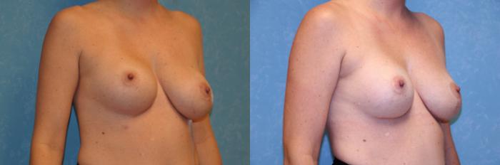 Before & After Complex Cases Case 462 Right Oblique View in Toledo, Ohio