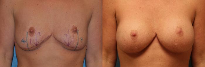 Before & After Breast Augmentation Case 475 Front View in Toledo, Ohio