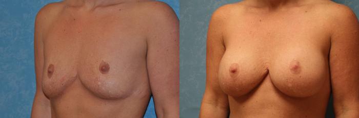Before & After Breast Augmentation Case 475 Left Oblique View in Toledo, Ohio