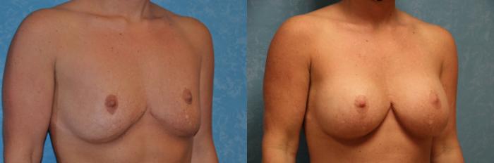 Before & After Breast Augmentation Case 475 Right Oblique View in Toledo, Ohio