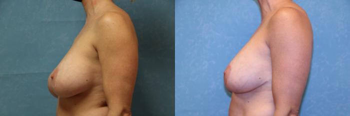 Before & After Complex Cases Case 479 Left Side View in Toledo, Ohio