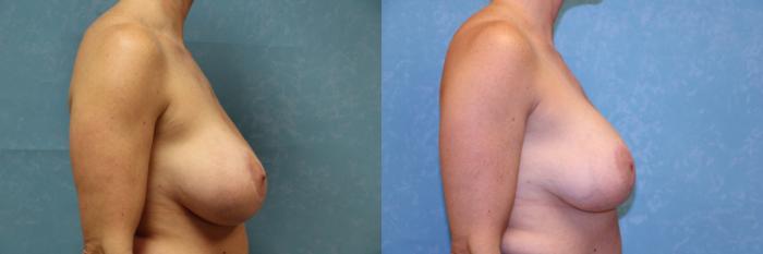 Before & After Complex Cases Case 479 Right Side View in Toledo, Ohio