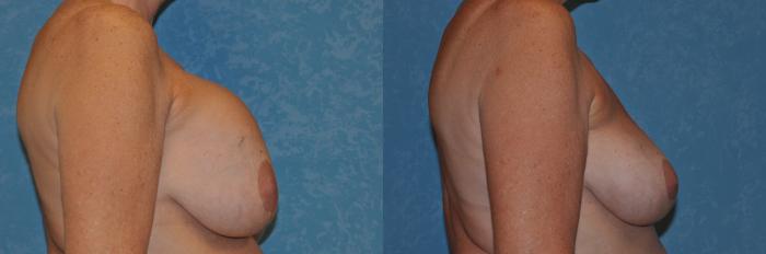Before & After Complex Cases Case 482 Right Side View in Toledo, Ohio