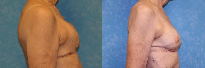 Before & After Complex Cases Case 483 Right Side View in Toledo, Ohio