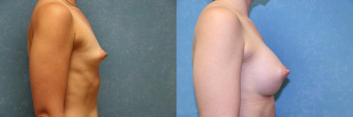 Before & After Complex Cases Case 484 Right Side View in Toledo, Ohio