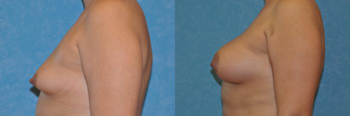 Before & After Complex Cases Case 485 Left Side View in Toledo, Ohio