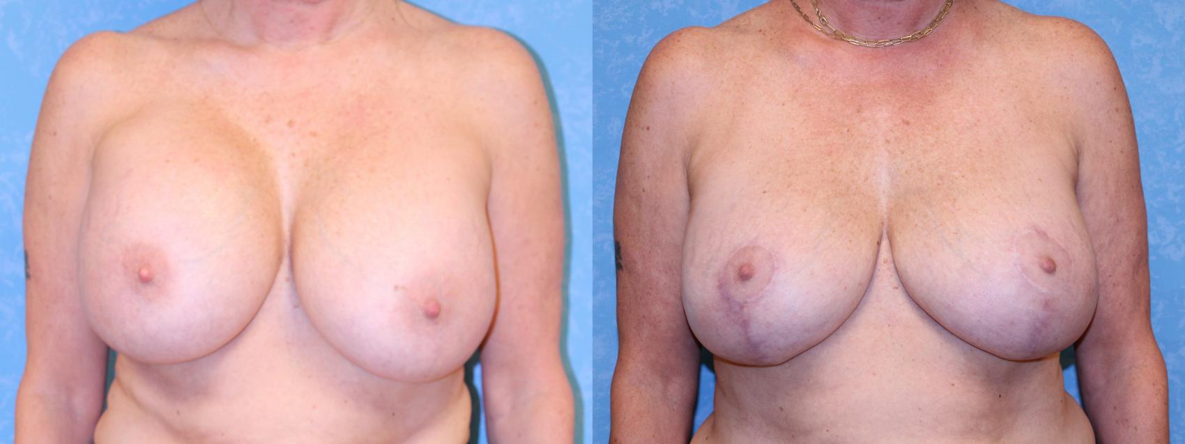 Before & After Breast Lift With Implants Case 524 Front View in Toledo, Ohio