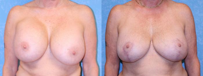 Before & After Breast Lift Case 524 Front View in Toledo, Ohio
