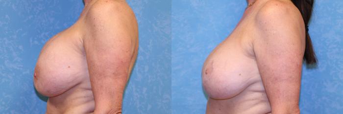 Before & After Breast Lift With Implants Case 524 Left Side View in Toledo, Ohio