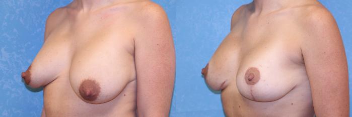 Before & After Complex Cases Case 538 Left Oblique View in Toledo, Ohio