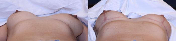 Before & After Complex Cases Case 538 Supine View in Toledo, Ohio