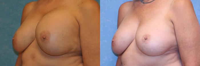 Before & After Complex Cases Case 544 Left Oblique View in Toledo, Ohio