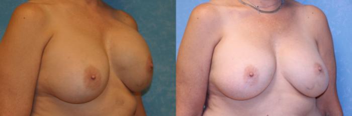 Before & After Complex Cases Case 544 Right Oblique View in Toledo, Ohio