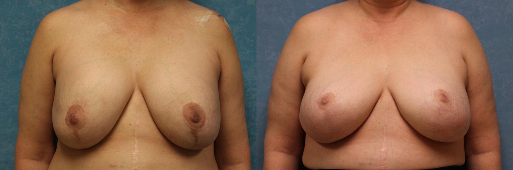 Before & After Implant Revision Case 555 Front View in Toledo, Ohio
