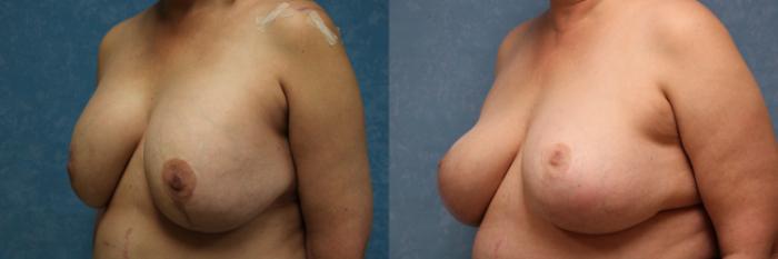 Before & After Implant Revision Case 555 Left Side View in Toledo, Ohio