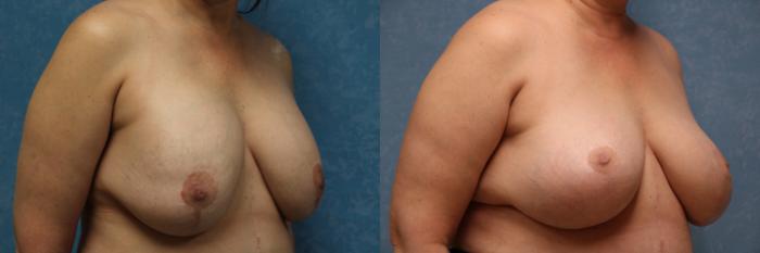 Before & After Implant Revision Case 555 Right Oblique View in Toledo, Ohio