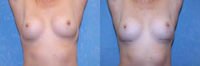 Before & After Complex Cases Case 561 Arms Up View in Toledo, Ohio