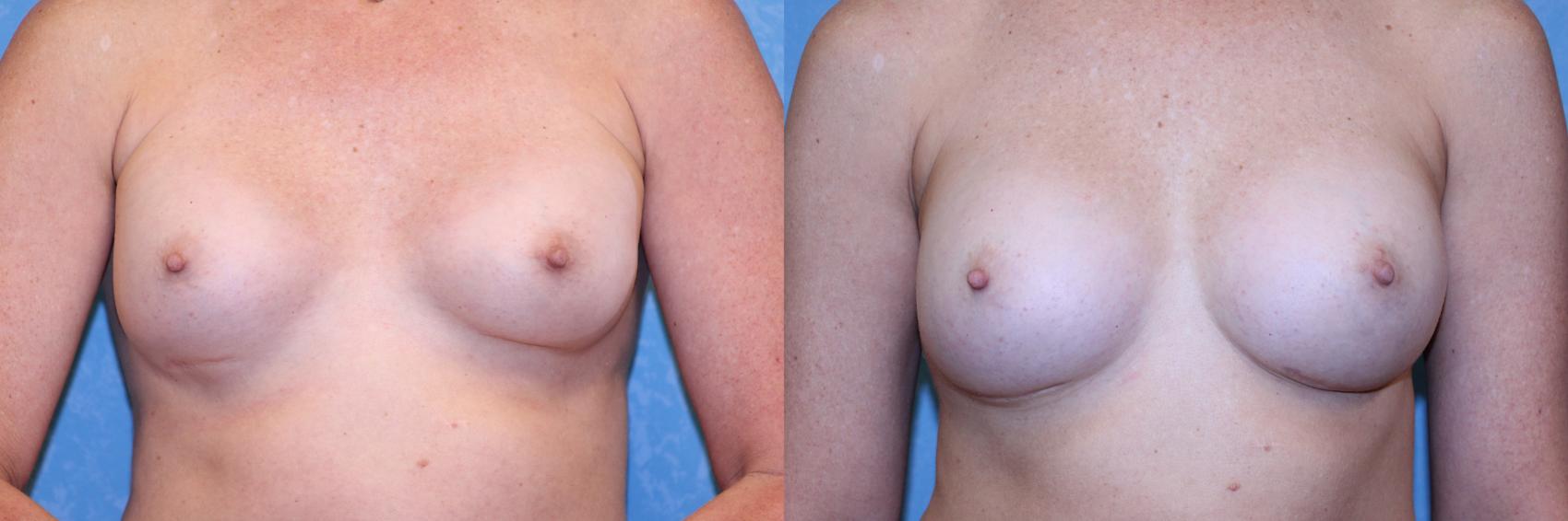 Before & After Complex Cases Case 561 Front View in Toledo, Ohio