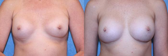 Before & After Complex Cases Case 561 Front View in Toledo, Ohio