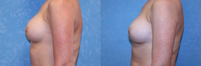 Before & After Complex Cases Case 561 Left Side View in Toledo, Ohio