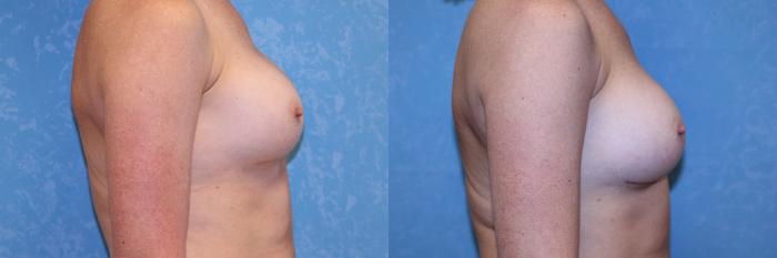 Before & After Complex Cases Case 561 Right Side View in Toledo, Ohio