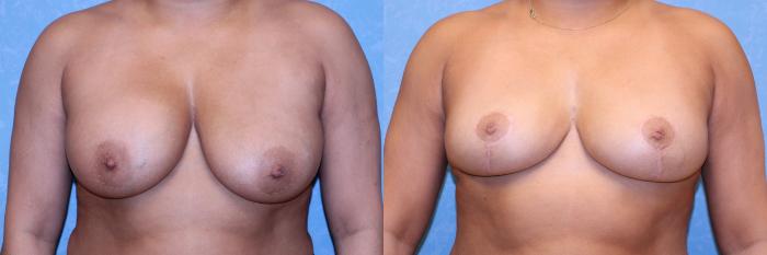 Before & After Complex Cases Case 566 Front View in Toledo, Ohio