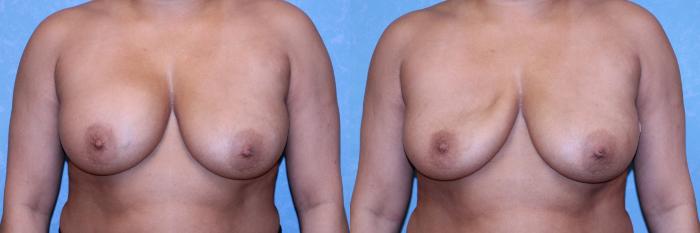 Before & After Complex Cases Case 566 Pre Op- Saline Implant Deflation View in Toledo, Ohio