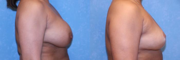 Before & After Complex Cases Case 566 Right Side View in Toledo, Ohio