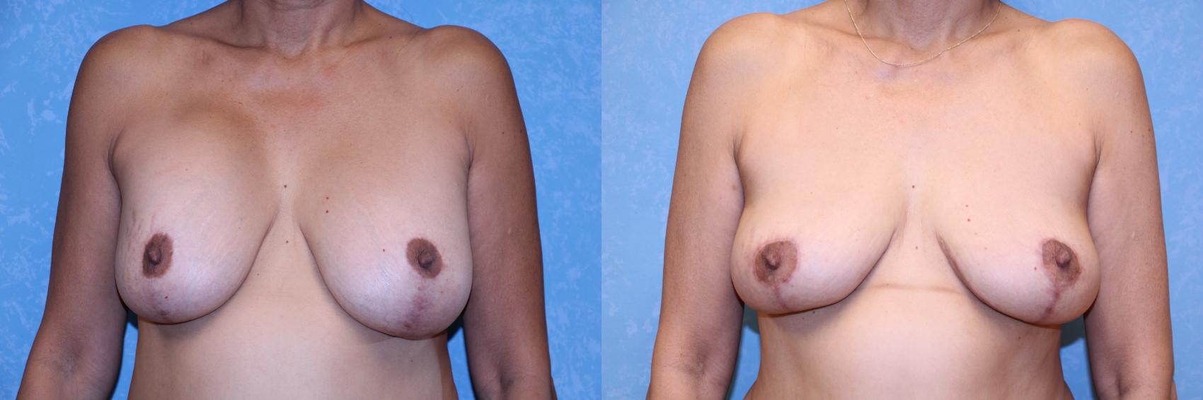Before & After Complex Cases Case 569 Front View in Toledo, Ohio