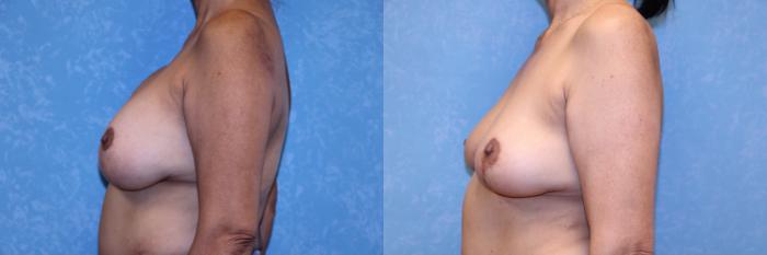 Before & After Complex Cases Case 569 Left Side View in Toledo, Ohio
