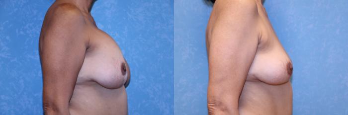 Before & After Complex Cases Case 569 Right Side View in Toledo, Ohio
