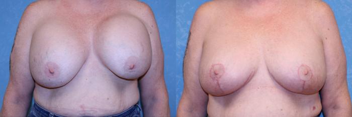 Before & After Complex Cases Case 575 Front View in Toledo, Ohio