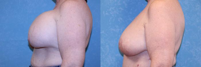 Before & After Complex Cases Case 575 Left Side View in Toledo, Ohio