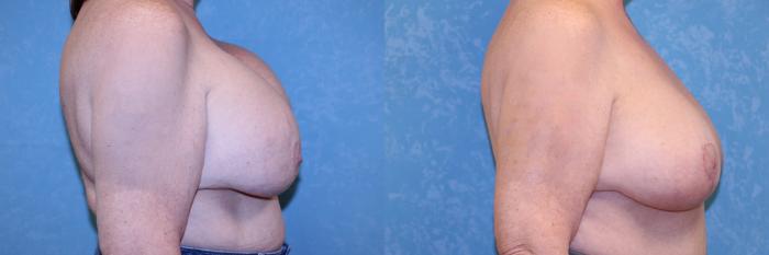 Before & After Complex Cases Case 575 Right Side View in Toledo, Ohio