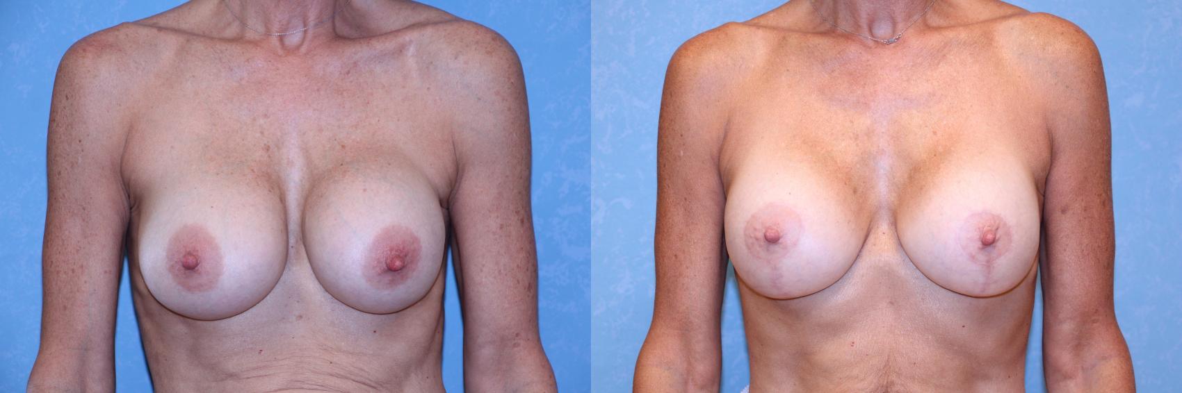 Before & After Complex Cases Case 585 Front View in Toledo, Ohio