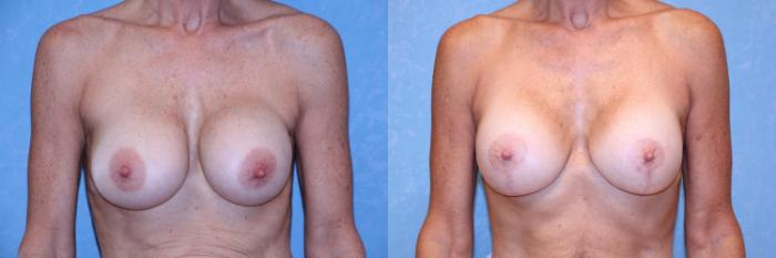 Before & After Complex Cases Case 585 Front View in Toledo, Ohio